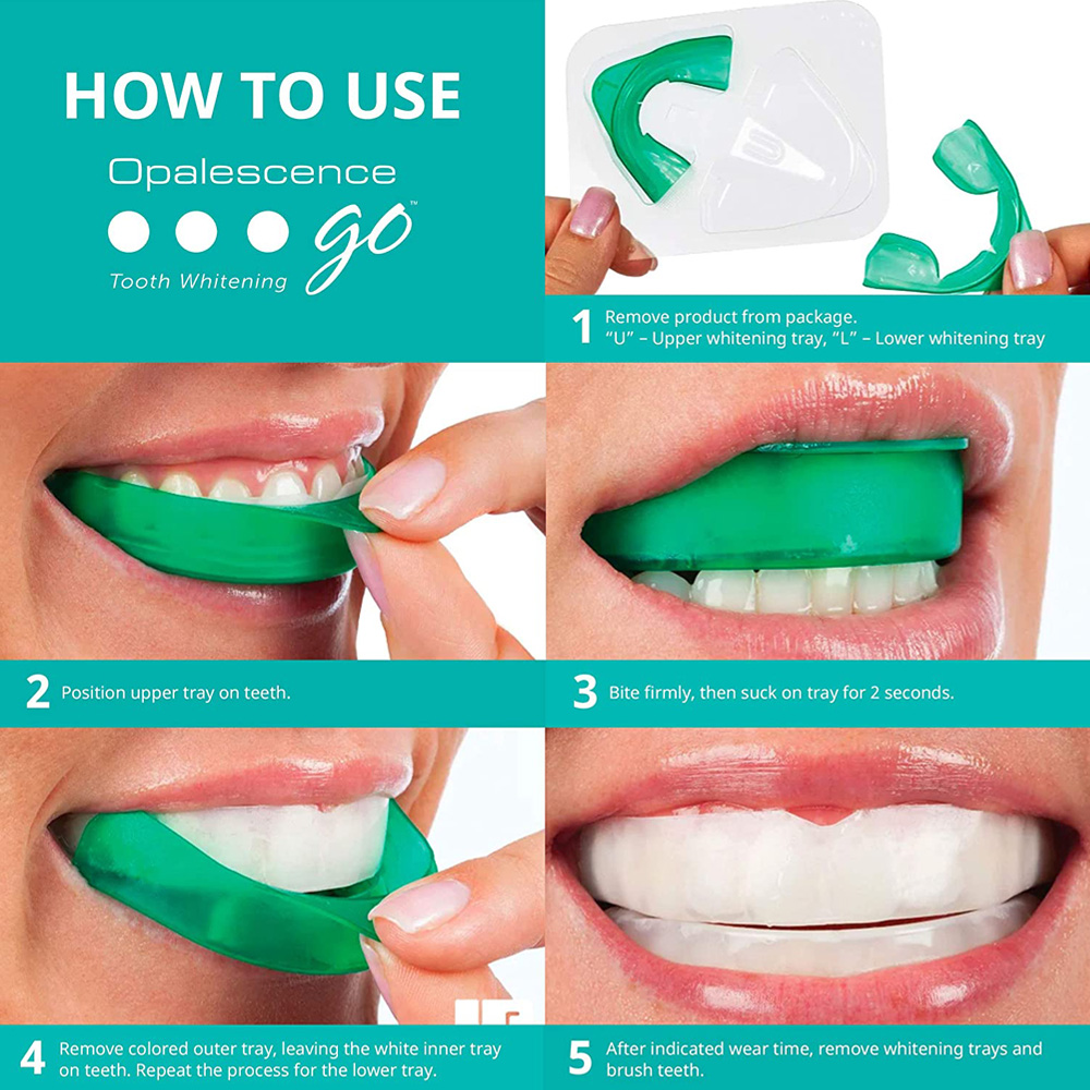 치아 미백용 과산화 수소, 유백광 고 프리필 트레이,  - Teeth Whitening Kit 리뷰 및 가격