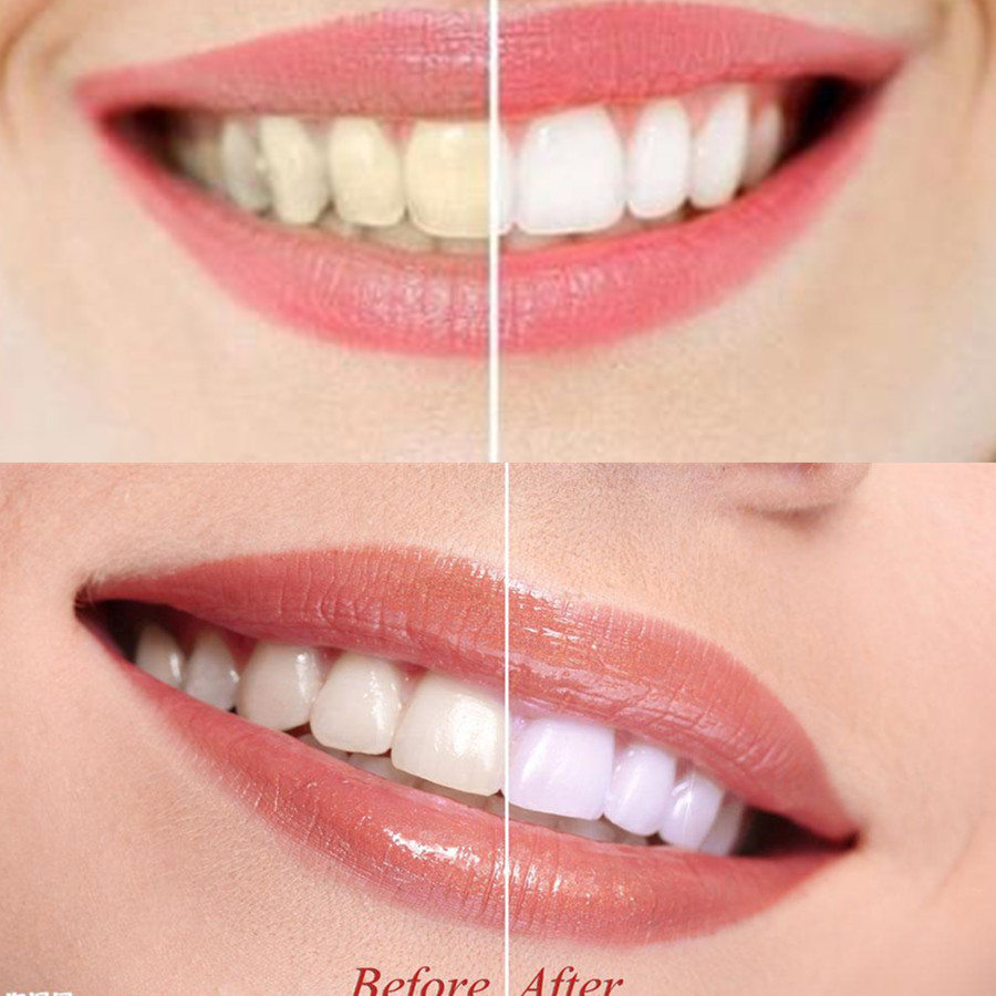 대나무 숯 치아 치아 Dentis Lab 구강 위생 관 - Teeth Whitening Kit 리뷰 및 가격