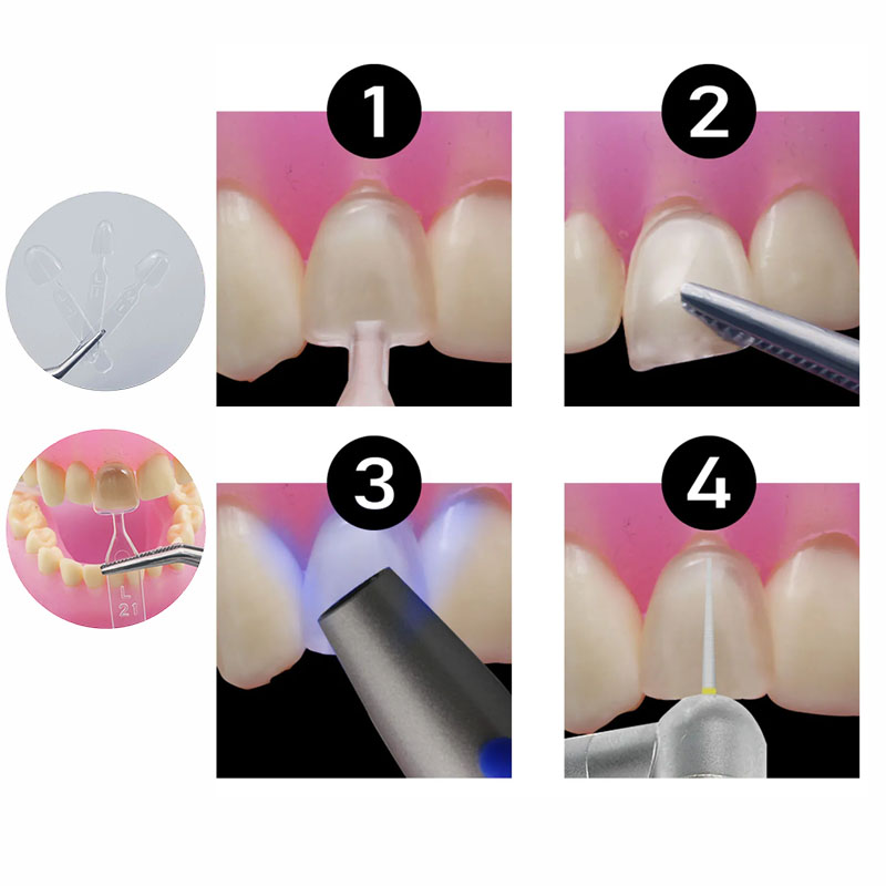 32개/세트 복합 레진 몰드 광중합 오토클레이브 치과용 - Teeth Whitening Moulds 리뷰 및 가격