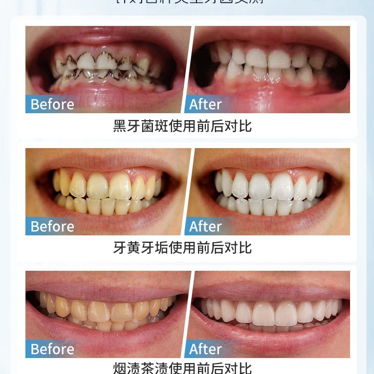 일본 수동 치아 얼룩 제거 브러시 구강 깊은 청소를위한 - Teeth Whitening Japan 리뷰 및 가격