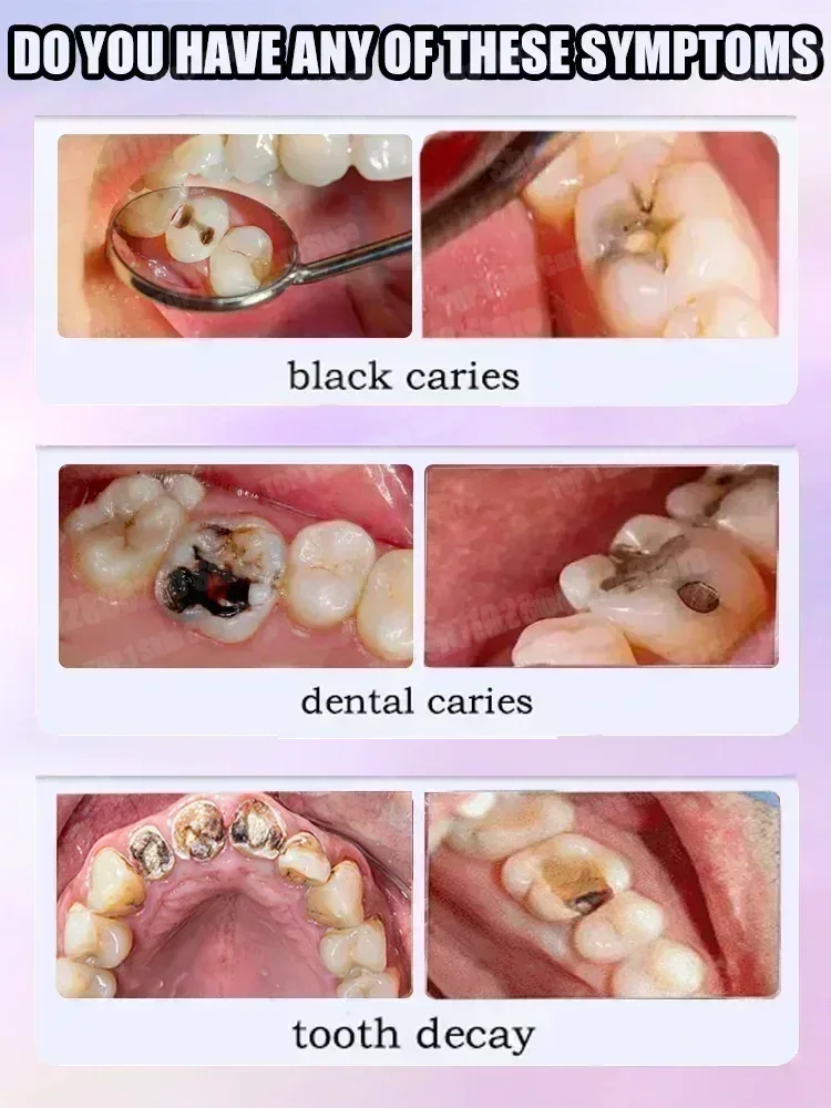 뜨거운 판매 베스트셀러, 과학적인 충치 수리, 충치 제 - Teeth Whitening That Works 리뷰 및 가격