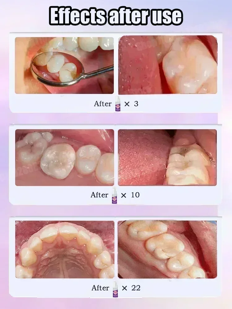 과학적인 공동 수리, 공동 제거, 플라크 청소, 치아  - Teeth Whitening That Works 리뷰 및 가격